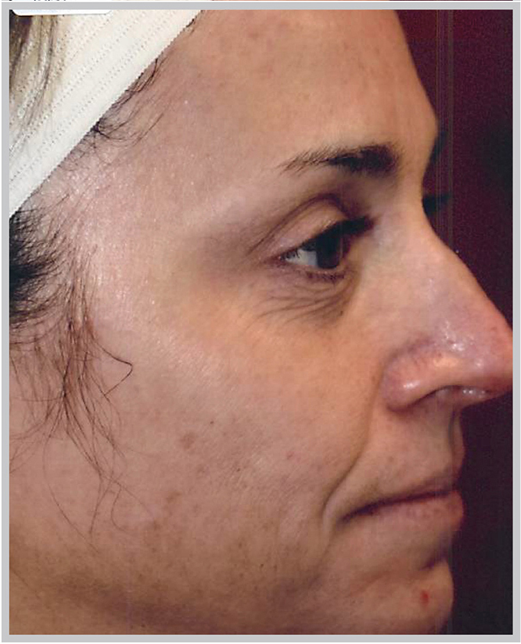 Glo Antiaging Calgary and Kelowna Before and After halo