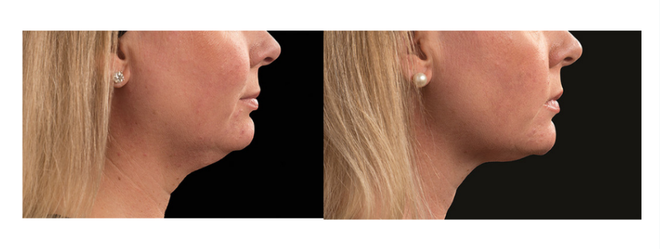Glo Antiaging Calgary and Kelowna Before and After