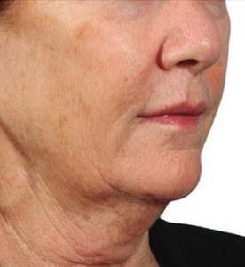 Glo Antiaging Calgary and Kelowna before and after