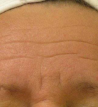 Glo Antiaging Calgary and Kelowna before and after