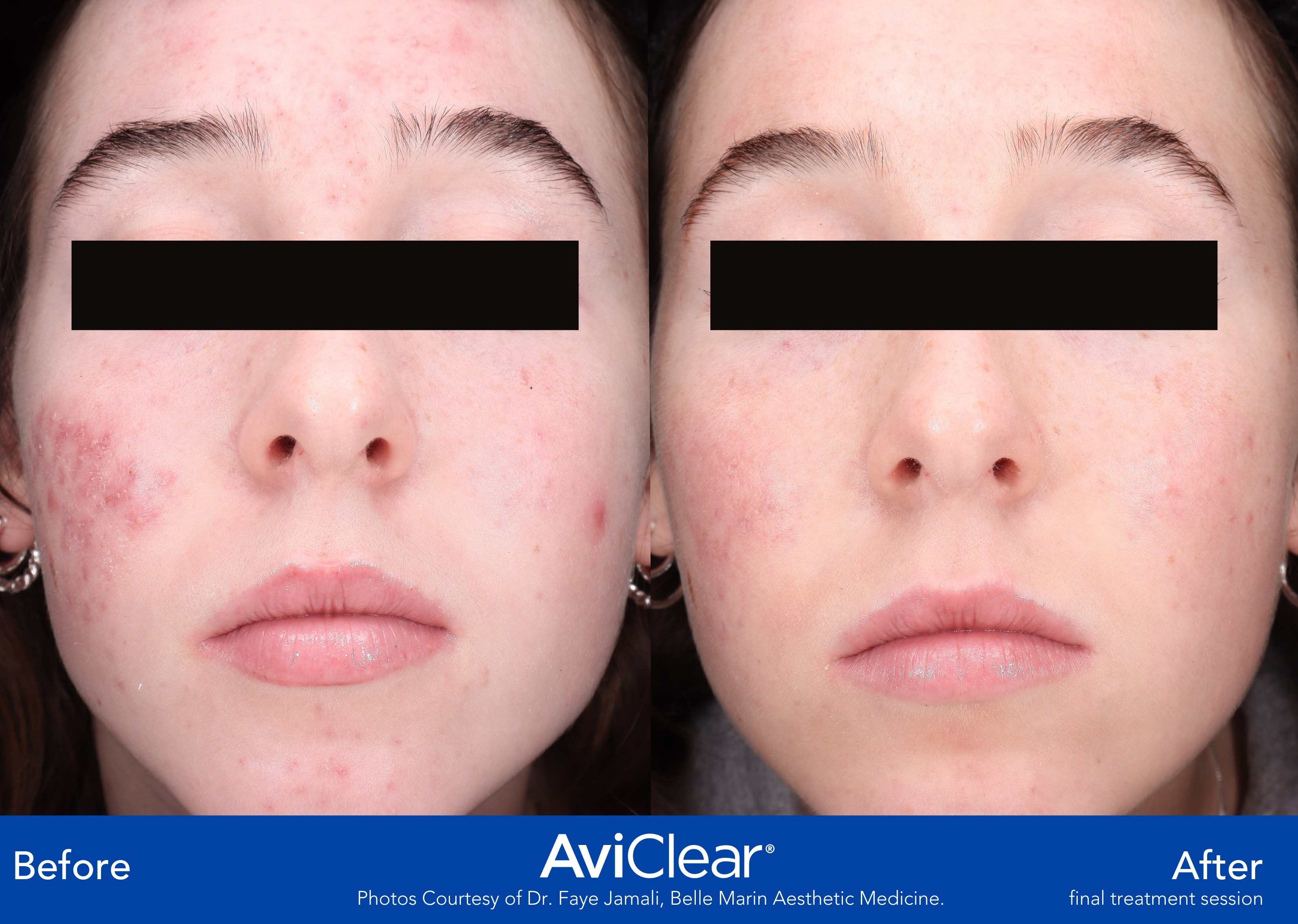 Glo Antiaging Calgary and Kelowna Before and After Aviclear