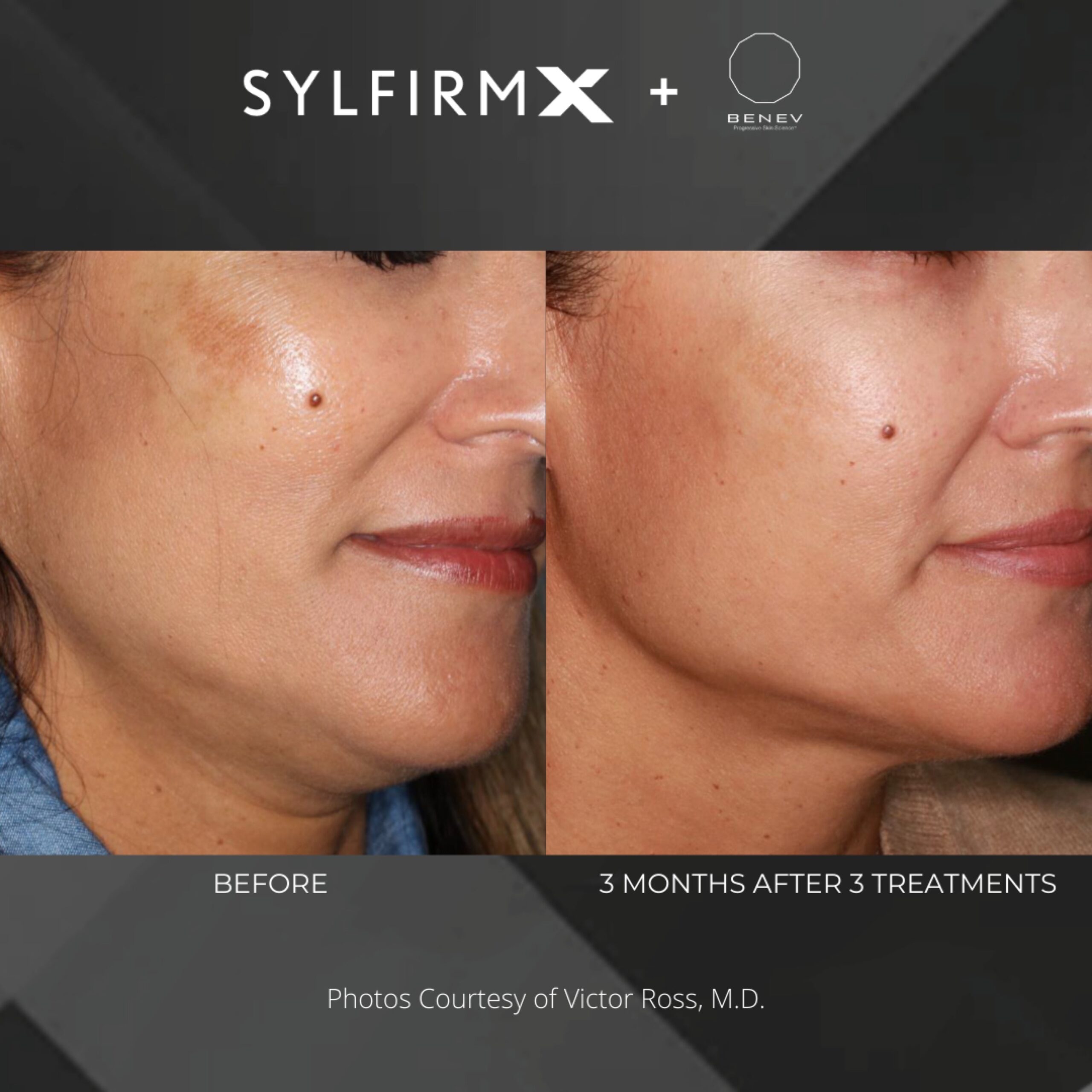 Sylfirm X Radio Frequency Microneedling Glo Antiaging Calgary and Kelowna Before and After