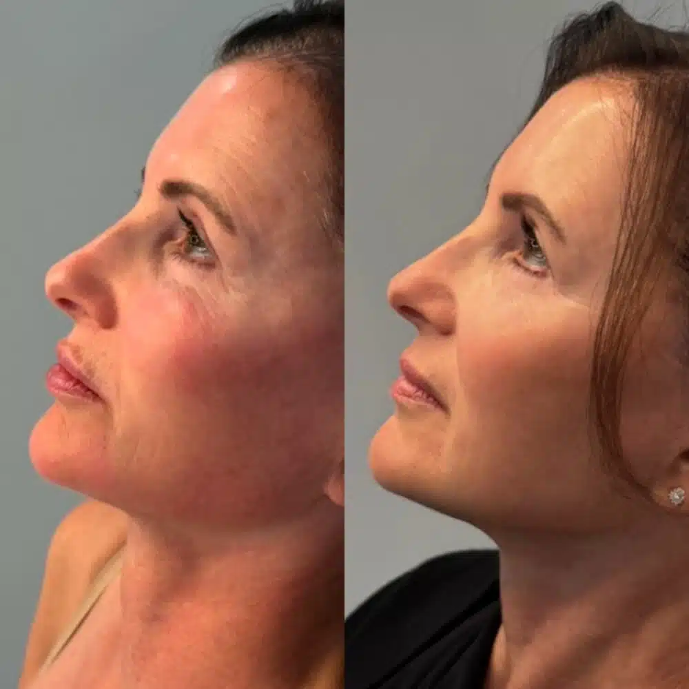 GLO Antiaging Calgary Kelowna Sculpt before and after side