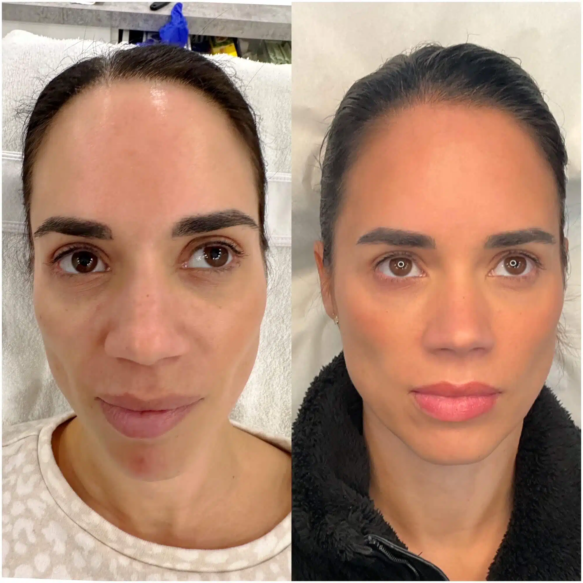 GLO Antiaging Calgary Kelowna Sculpt before and after front