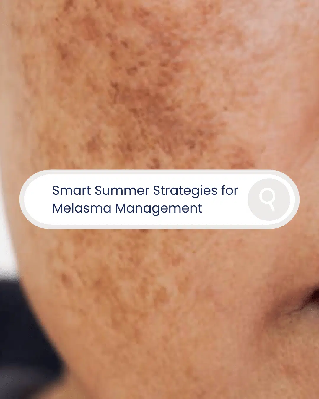 Featured image for “Smart Summer Strategies for Melasma Management”