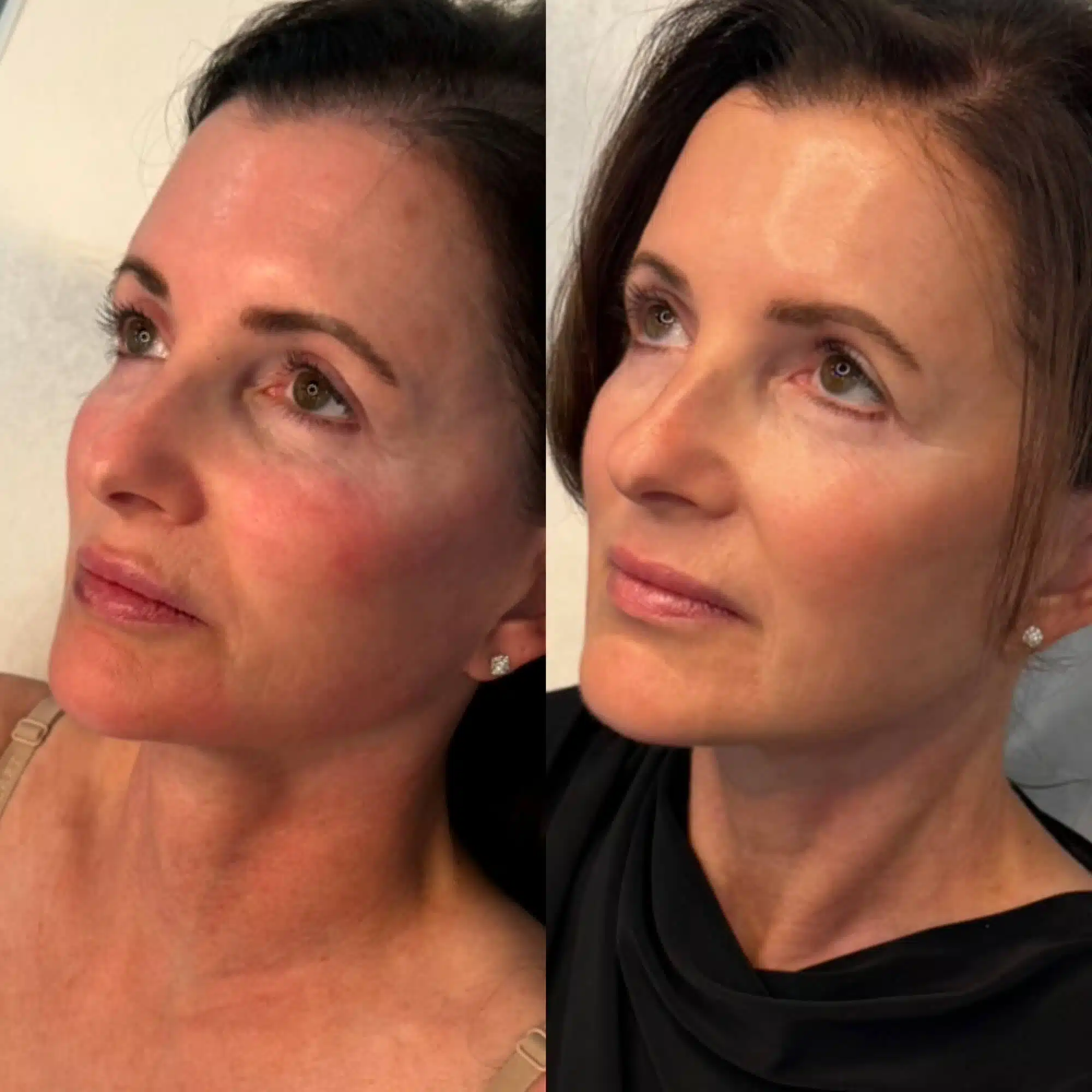 GLO Antiaging Calgary Kelowna side