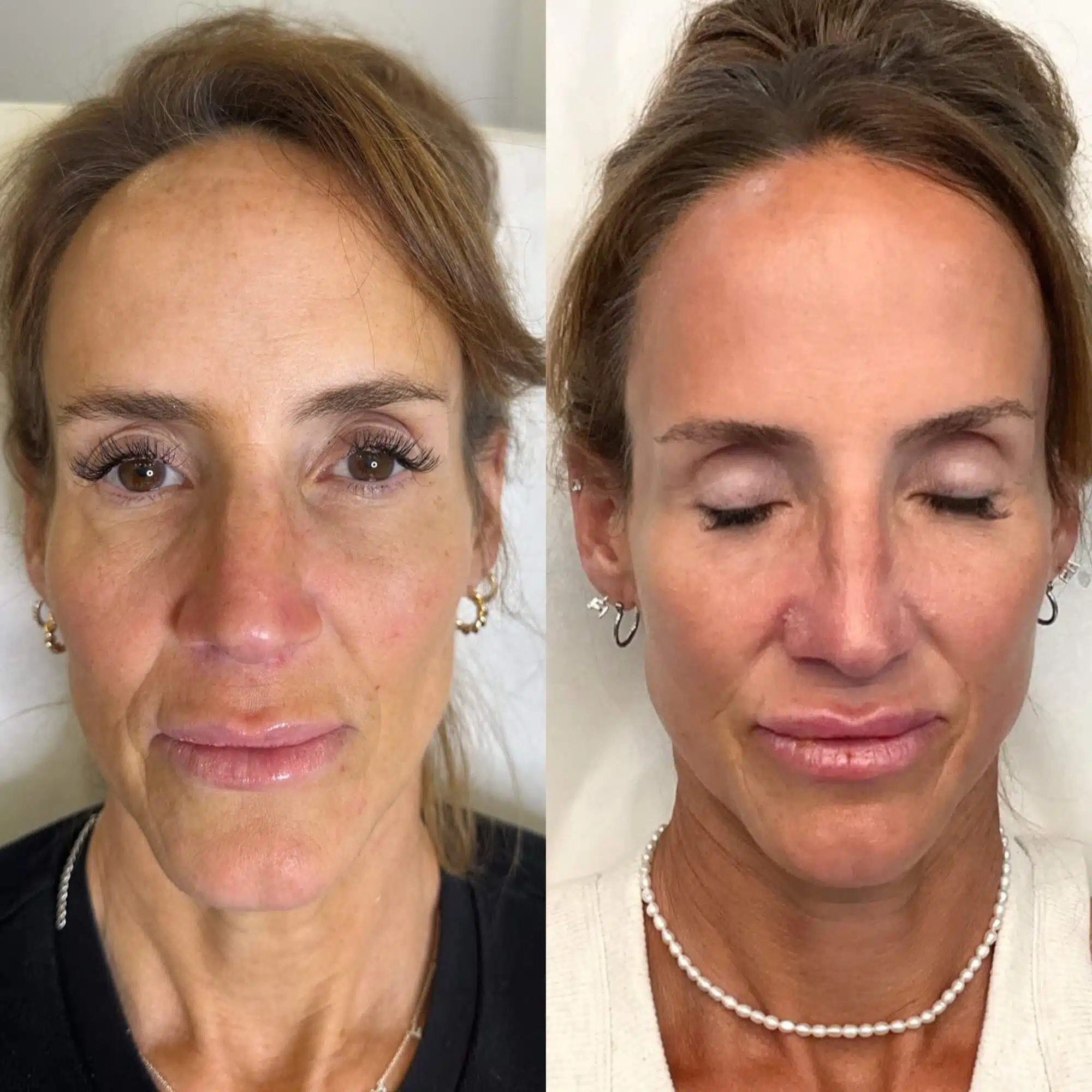 GLO Antiaging Calgary Kelowna Sculpt before and after front