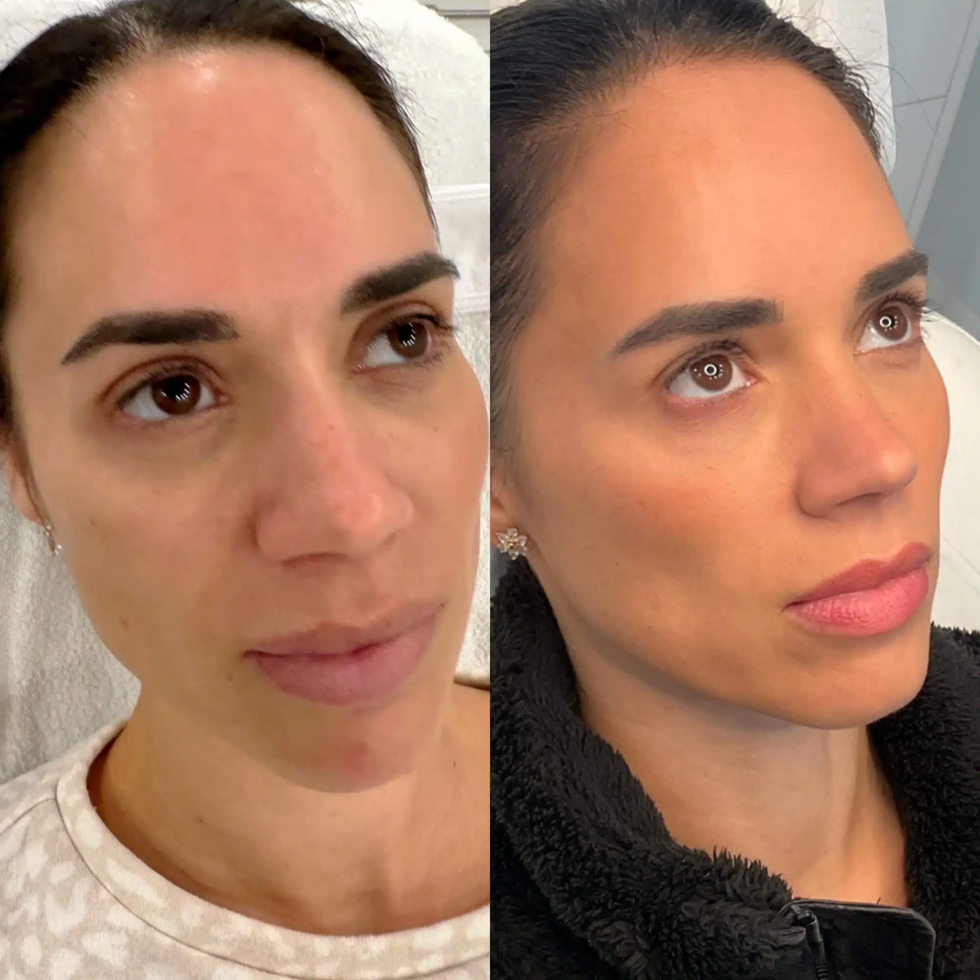 GLO Antiaging Calgary Kelowna Sculpt before and after side