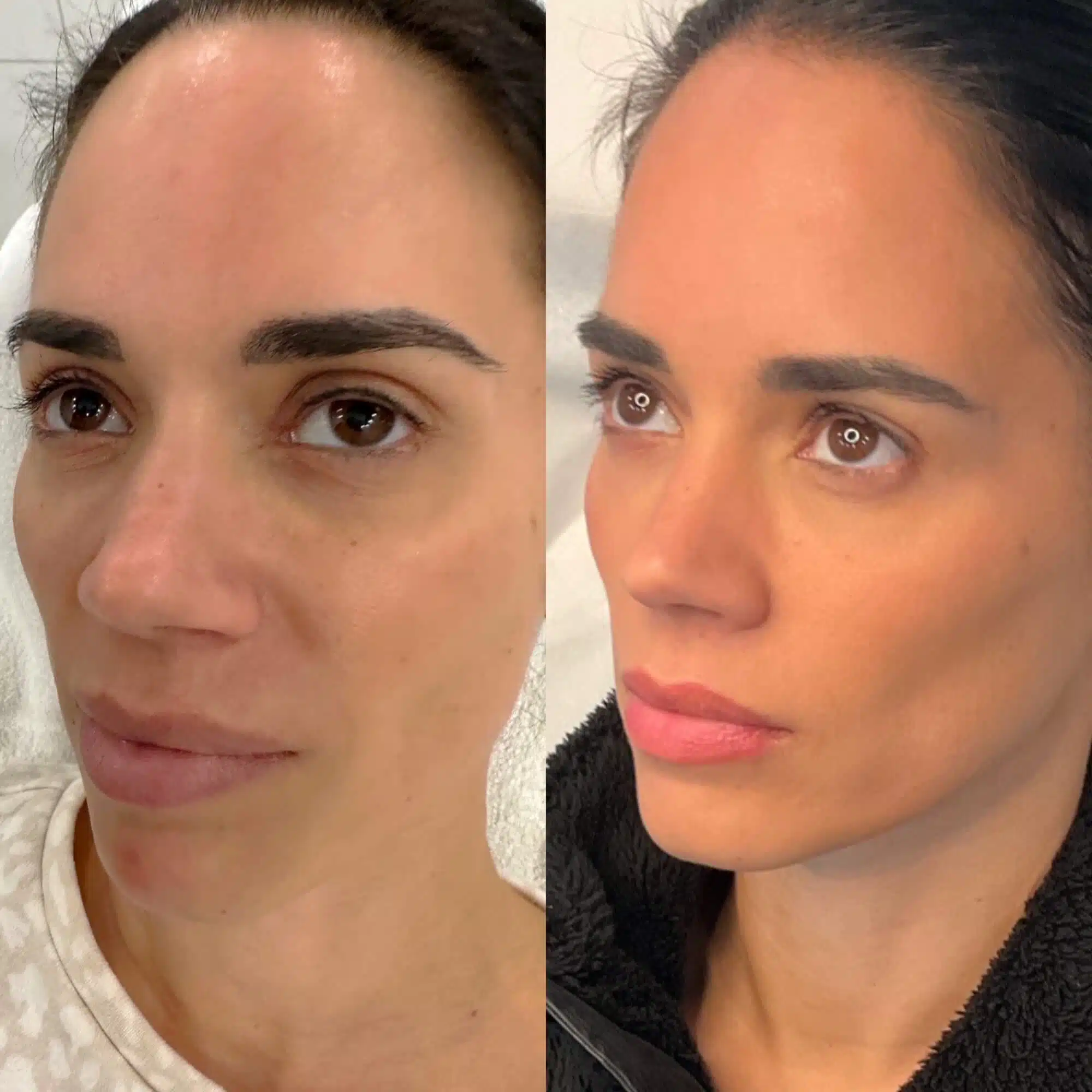 GLO Antiaging Calgary Kelowna Sculpt before and after side