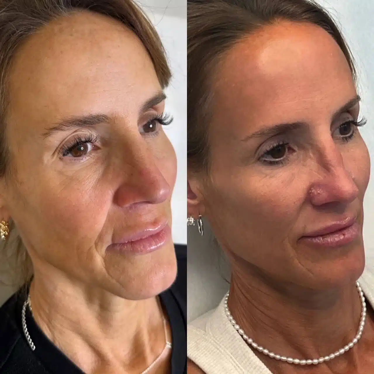 GLO Antiaging Calgary Kelowna Sculpt before and after side