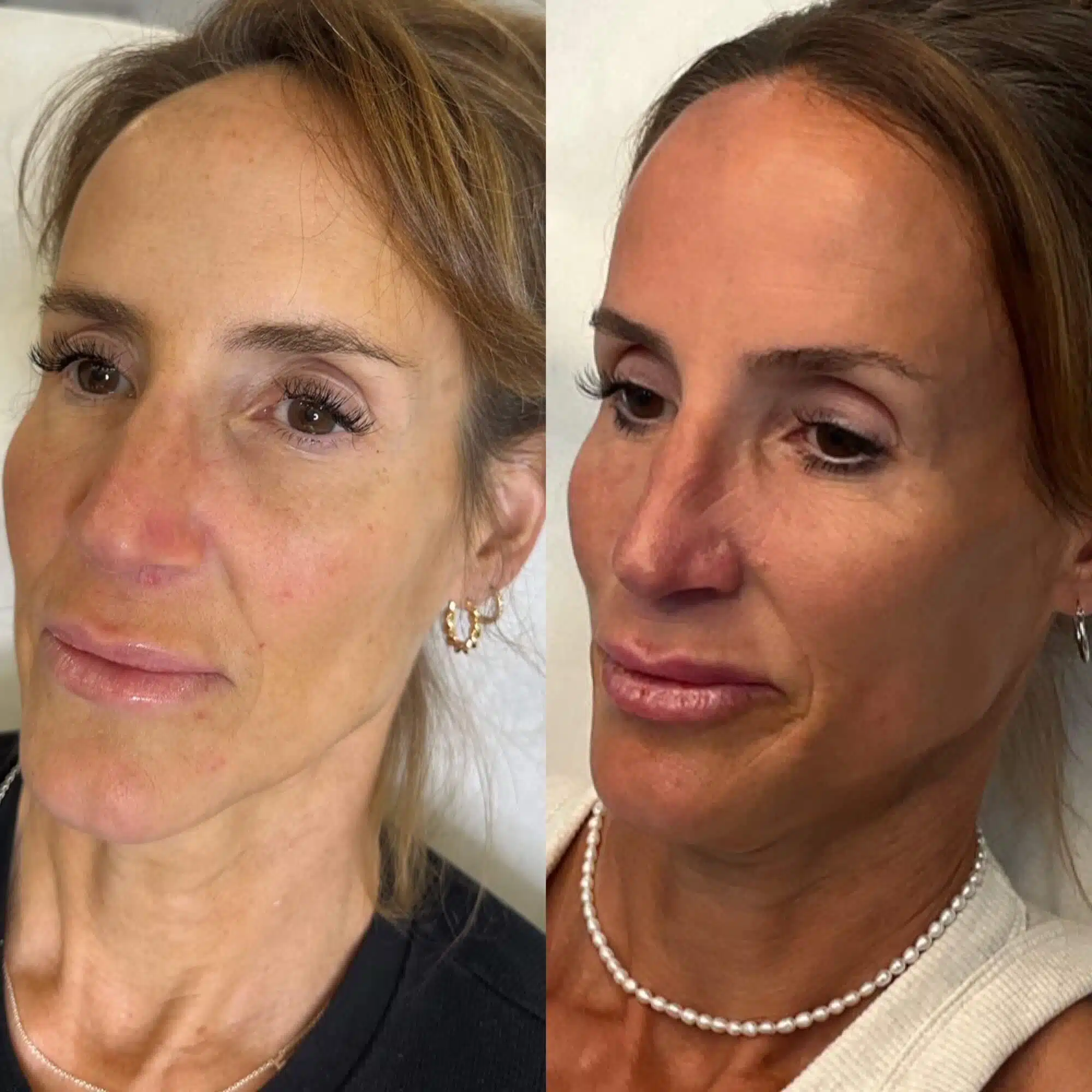 GLO Antiaging Calgary Kelowna Sculpt before and after side