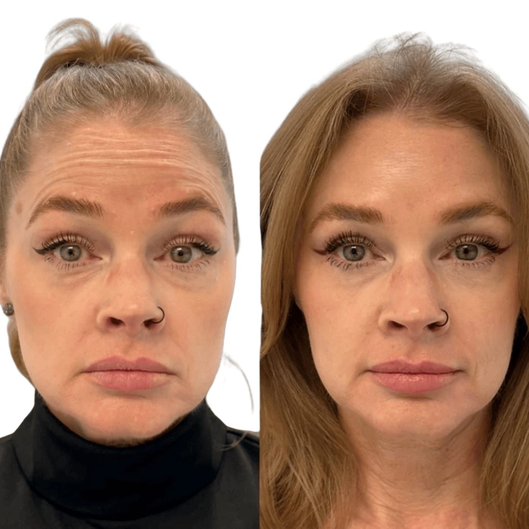 Glo Antiaging Calgary and Kelowna Botox before and after woman forehead