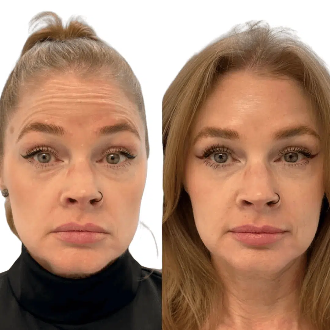 Glo Antiaging Calgary and Kelowna Botox before and after woman forehead