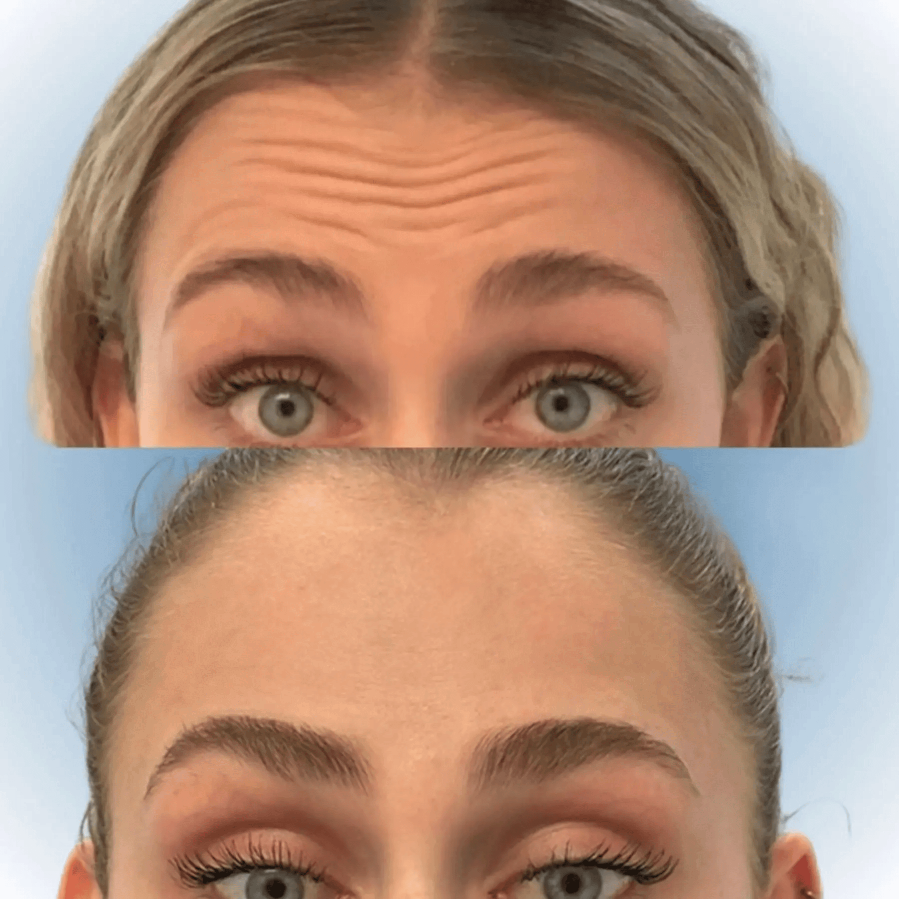 woman forehead Glo Antiaging Calgary and Kelowna Botox before and after