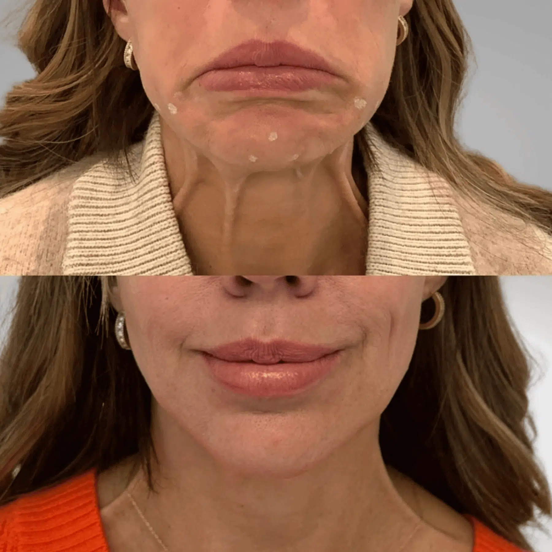 Glo Antiaging Calgary and Kelowna Botox before and after lower face