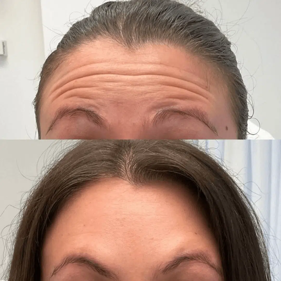 forehead close up Glo Antiaging Calgary and Kelowna Botox before and after