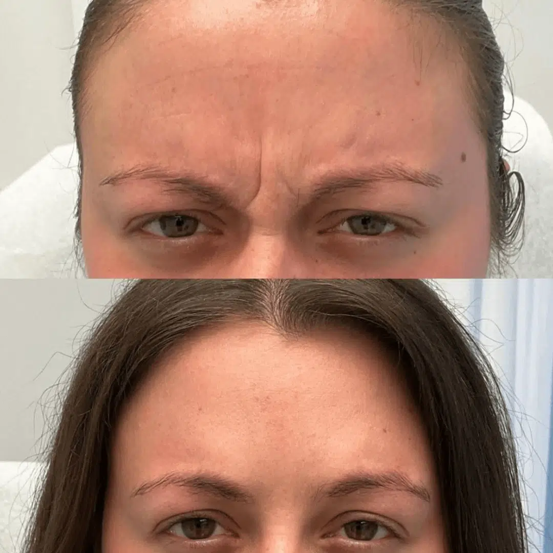 forehead close up Glo Antiaging Calgary and Kelowna Botox before and after