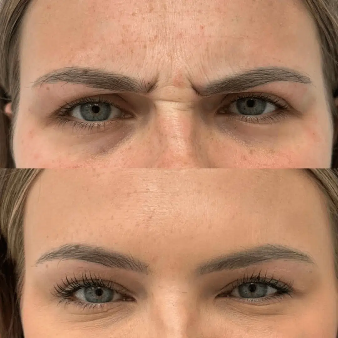 forehead close up Glo Antiaging Calgary and Kelowna Botox before and after