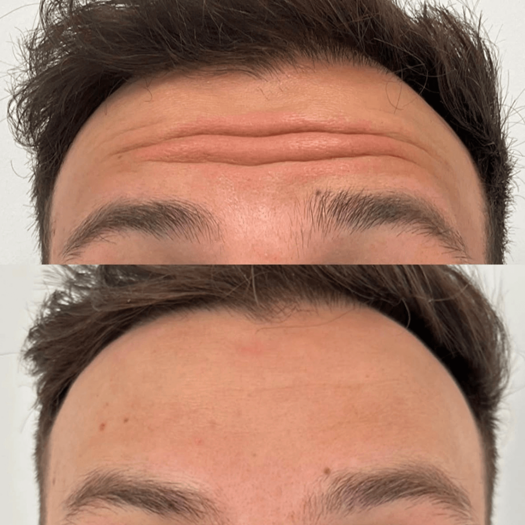 Glo Antiaging Calgary and Kelowna Botox before and after forehead close up