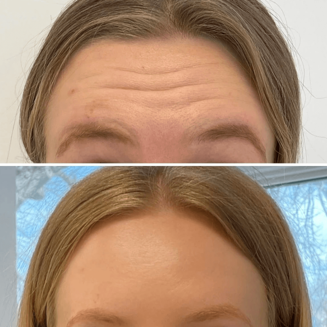 women's forehead close up Glo Antiaging Calgary and Kelowna Botox before and after