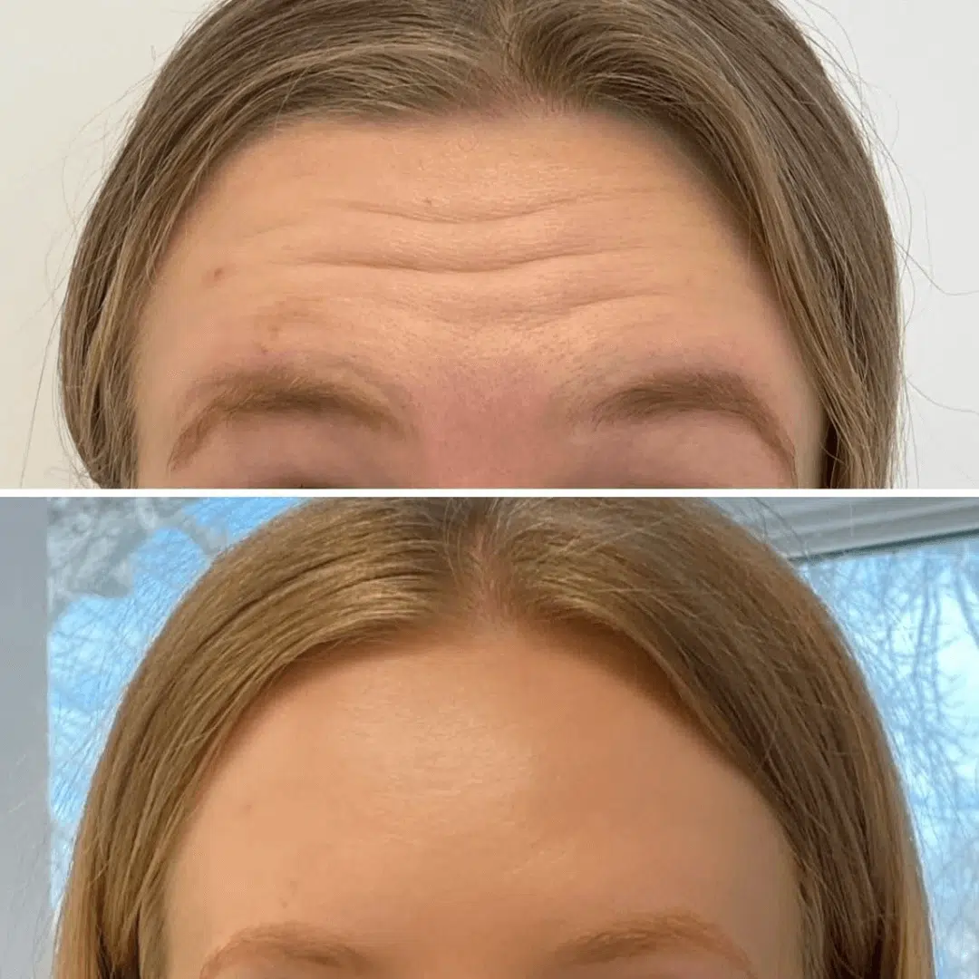women's forehead close up Glo Antiaging Calgary and Kelowna Botox before and after