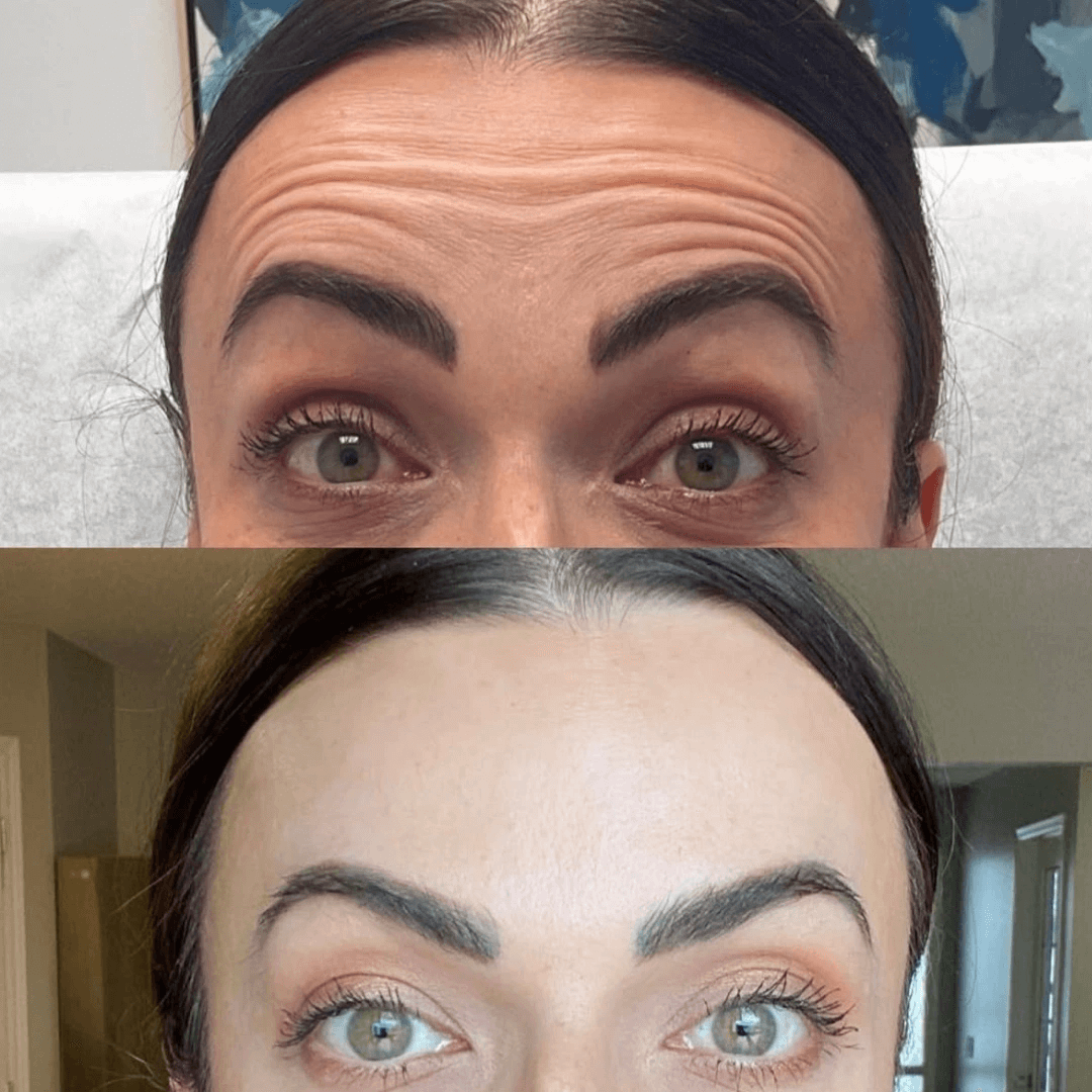 woman's forehead Glo Antiaging Calgary and Kelowna Botox before and after