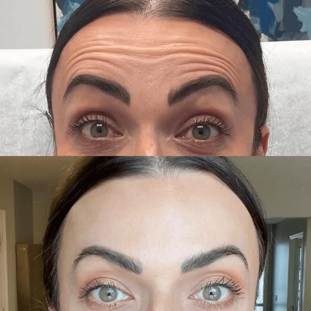 woman's forehead Glo Antiaging Calgary and Kelowna Botox before and after