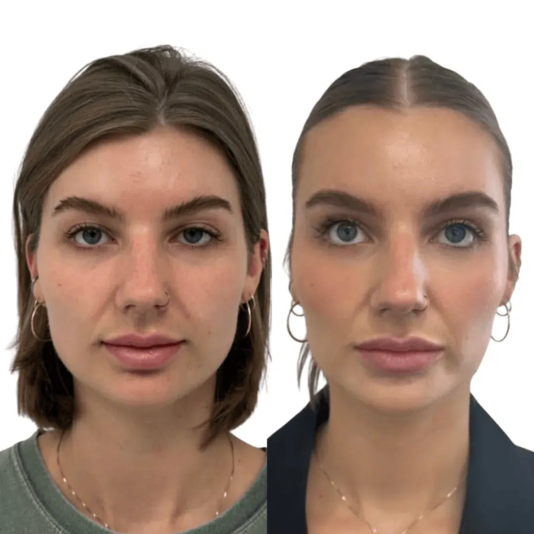 Glo Antiaging Calgary and Kelowna Botox before and after