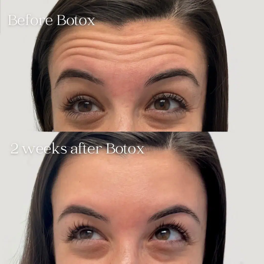 woman's forehead Glo Antiaging Calgary and Kelowna Botox before and after