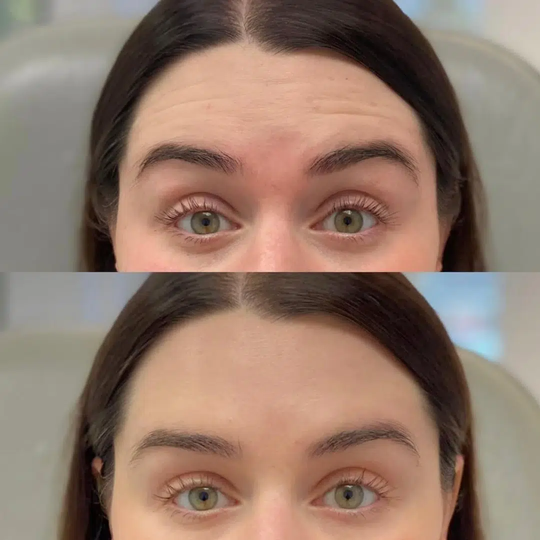 Glo Antiaging Calgary and Kelowna Botox before and after forehead close up