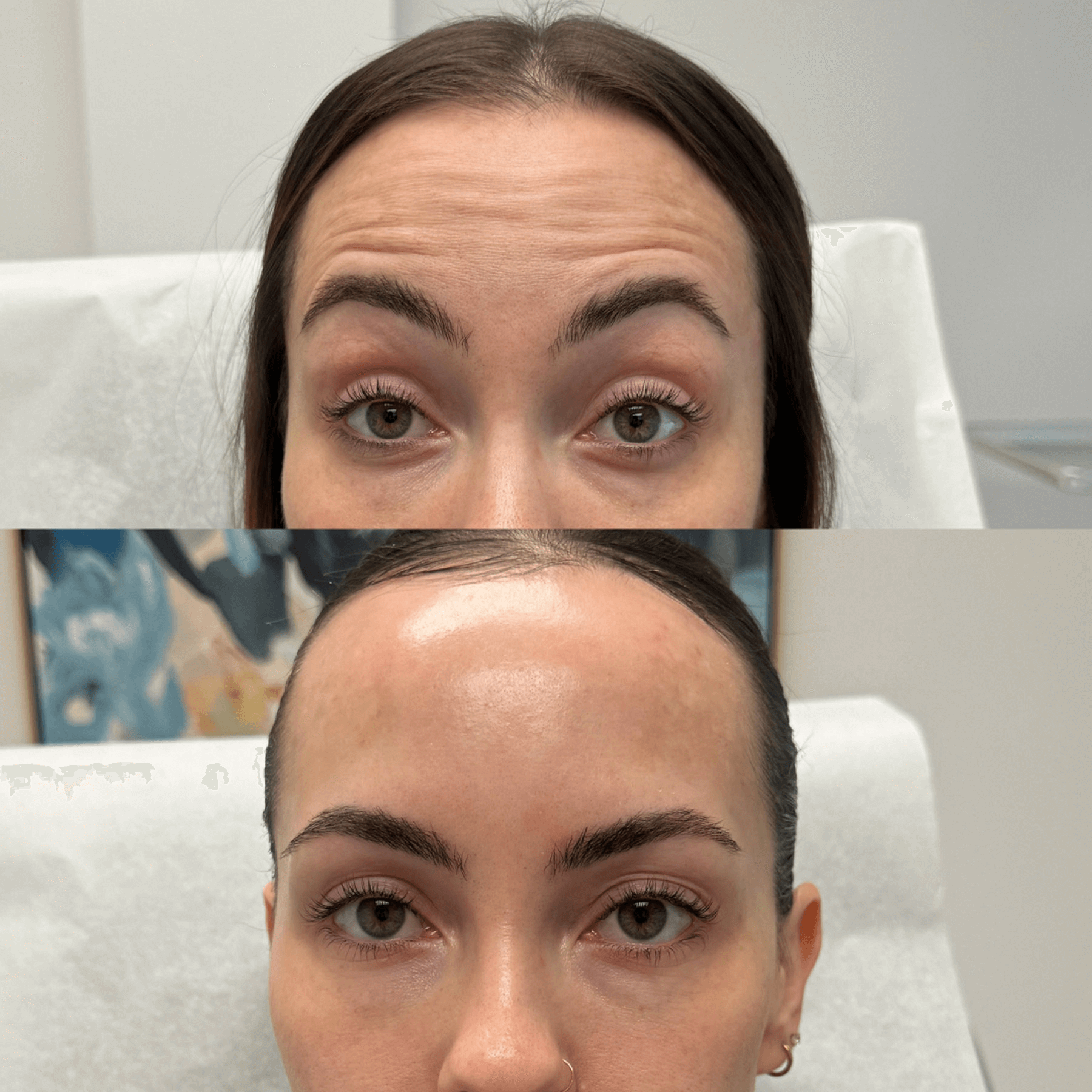Glo Antiaging Calgary and Kelowna Botox before and after forehead close up