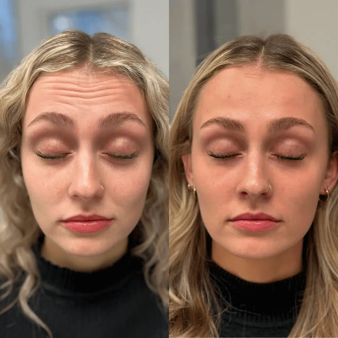Glo Antiaging Calgary and Kelowna Botox before and after woman's forehead