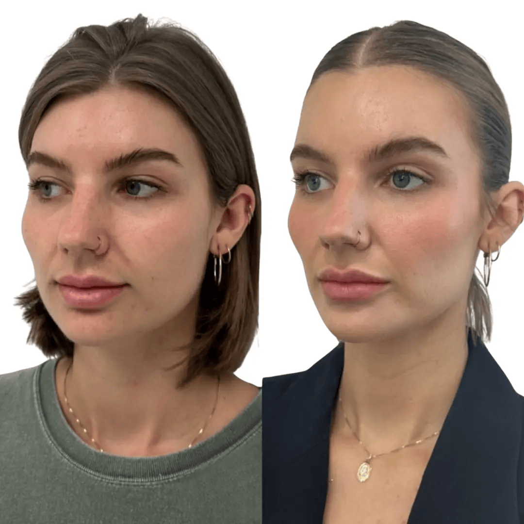 side profile Glo Antiaging Calgary and Kelowna Botox before and after