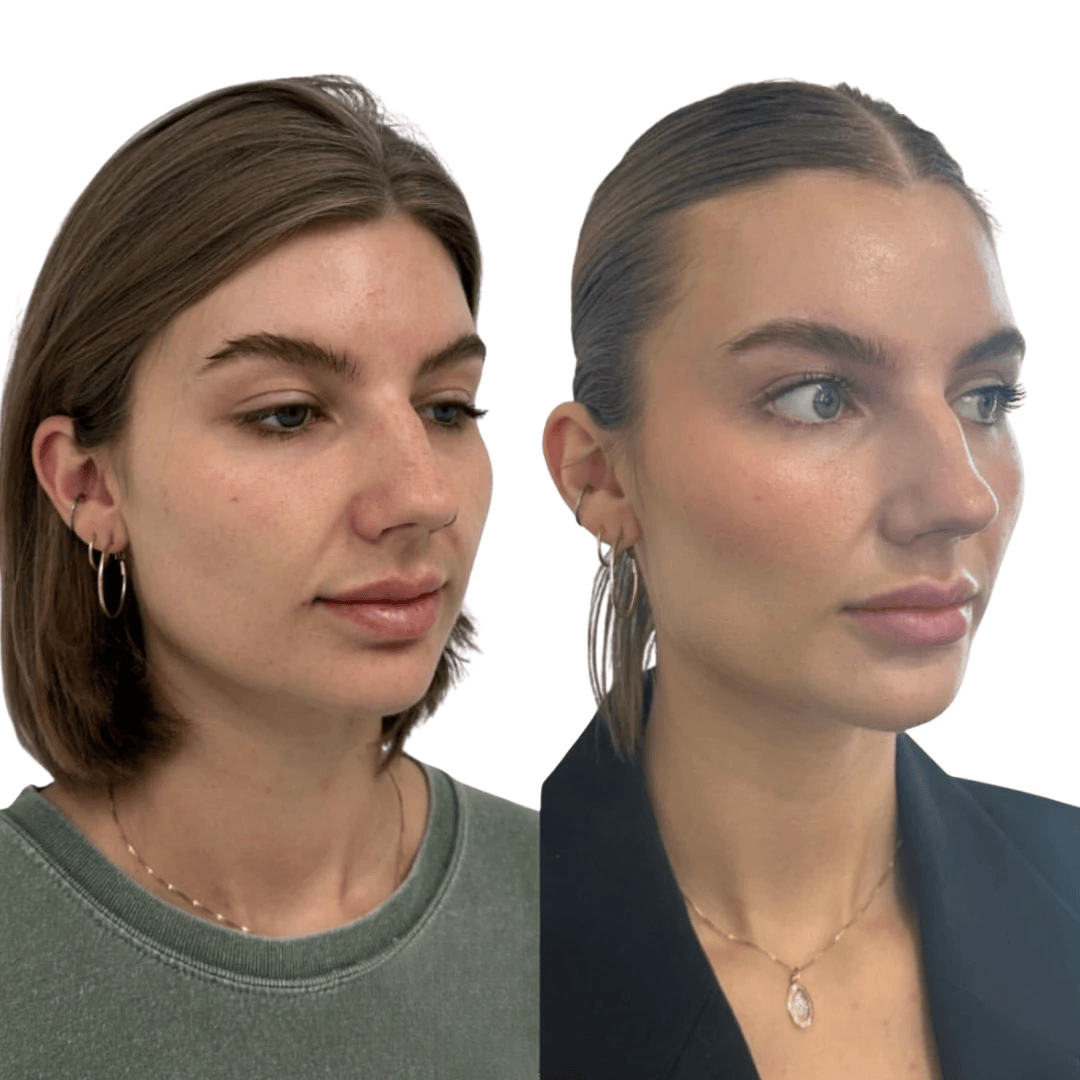 side profile Glo Antiaging Calgary and Kelowna Botox before and after