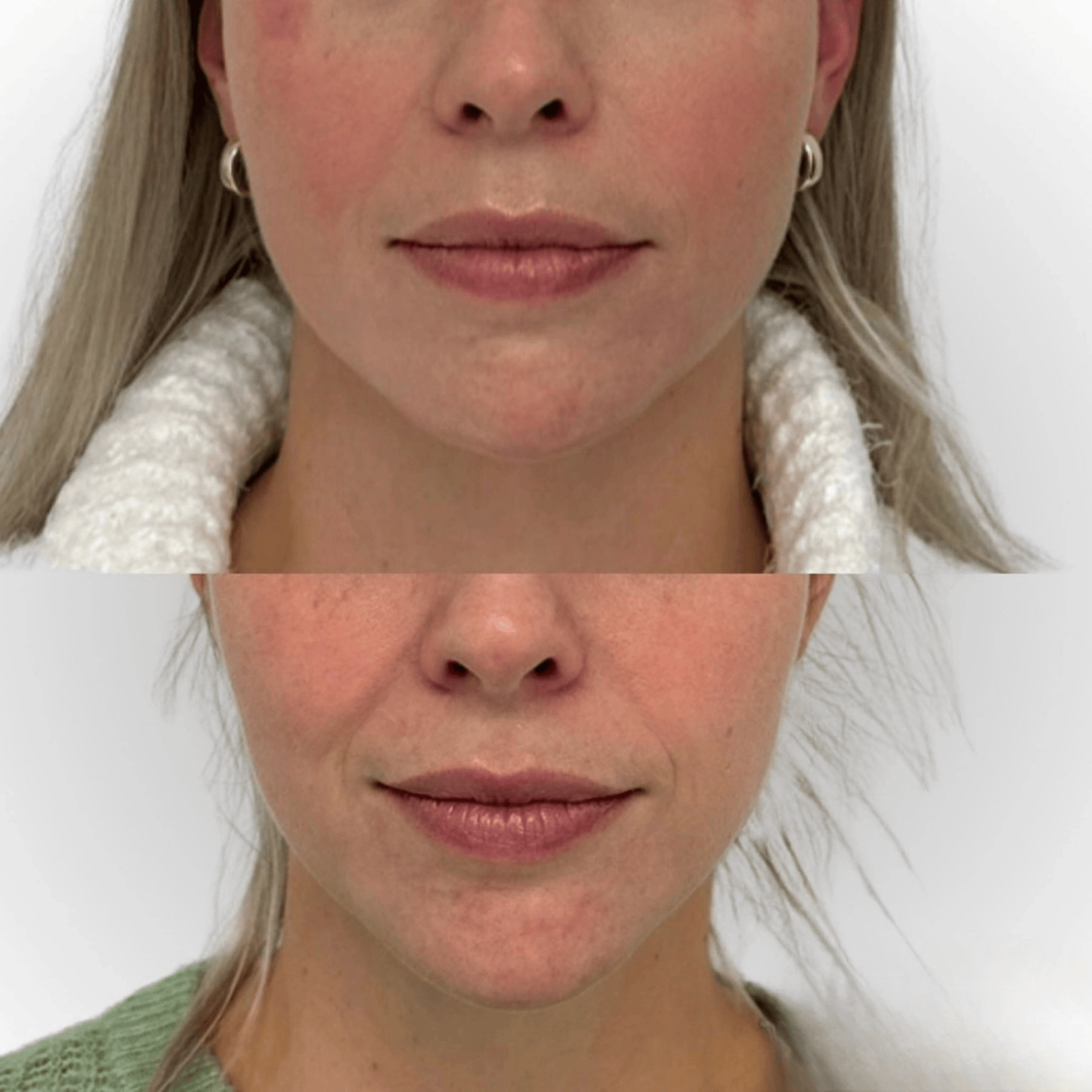 lower face Glo Antiaging Calgary and Kelowna Botox before and after