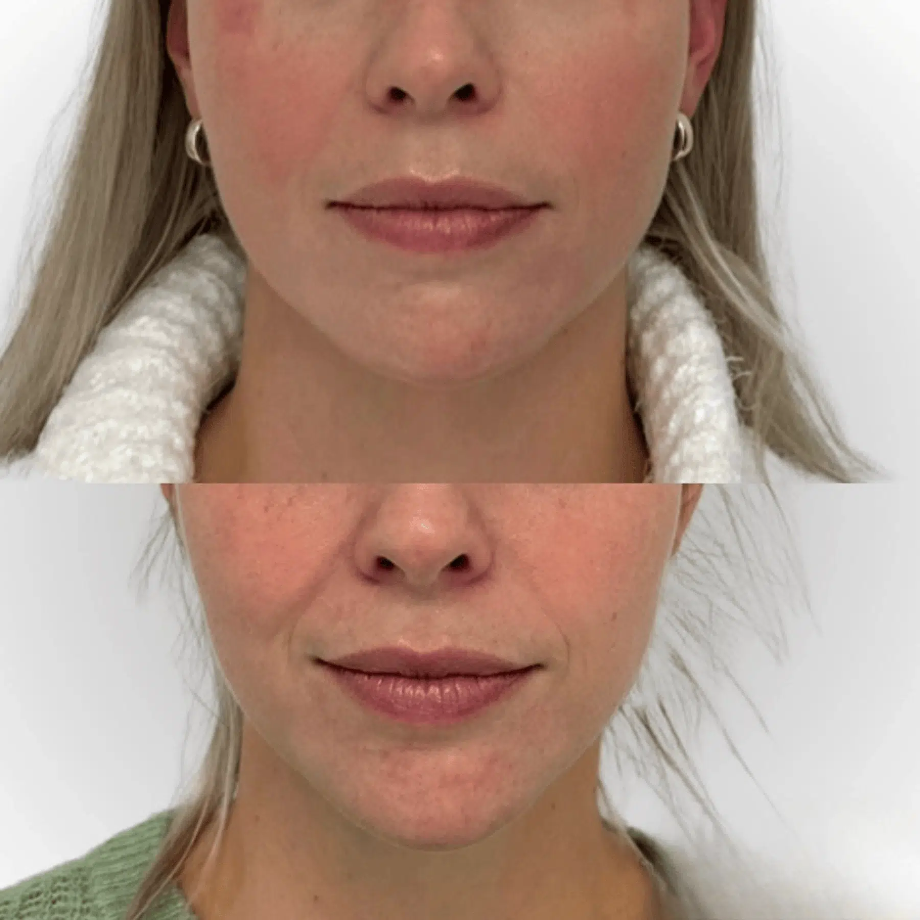 lower face Glo Antiaging Calgary and Kelowna Botox before and after