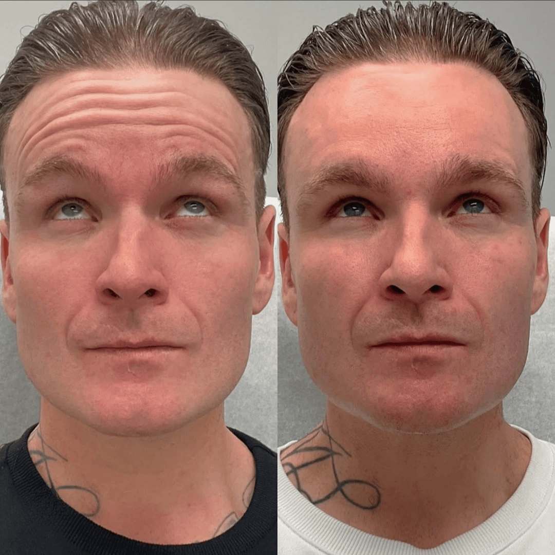 Glo Antiaging Calgary and Kelowna Botox before and after main forhead