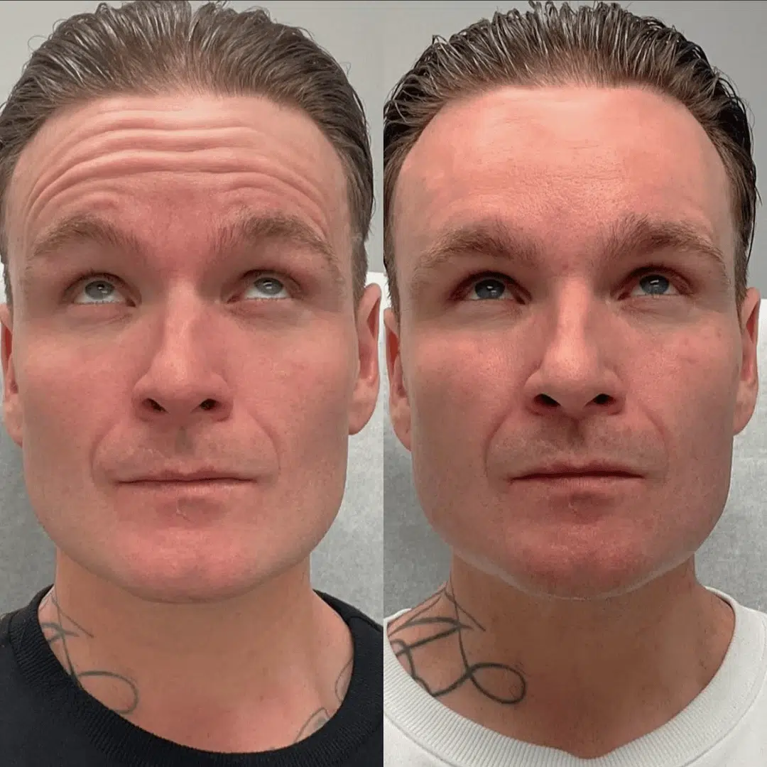 Glo Antiaging Calgary and Kelowna Botox before and after main forhead