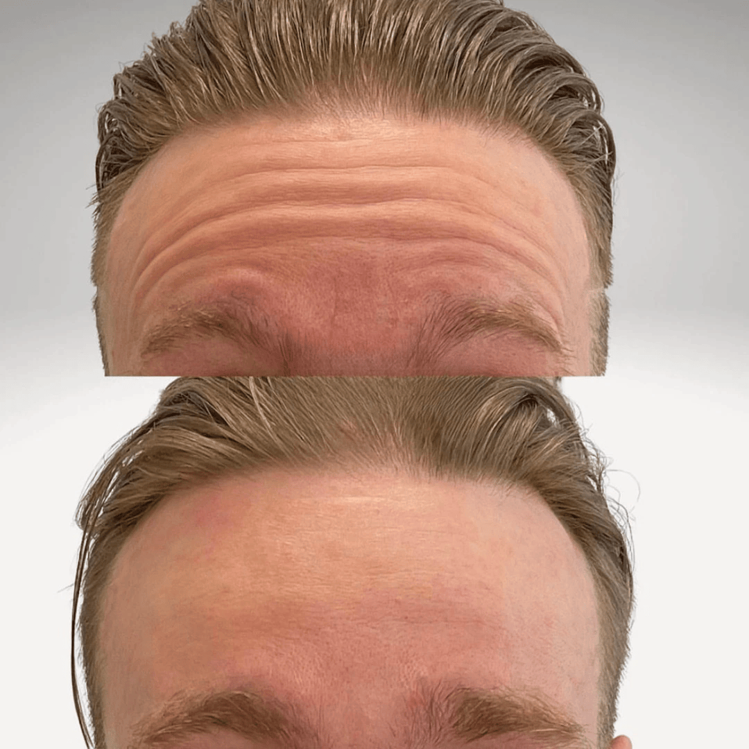 Glo Antiaging Calgary and Kelowna Botox before and after man forehead close up