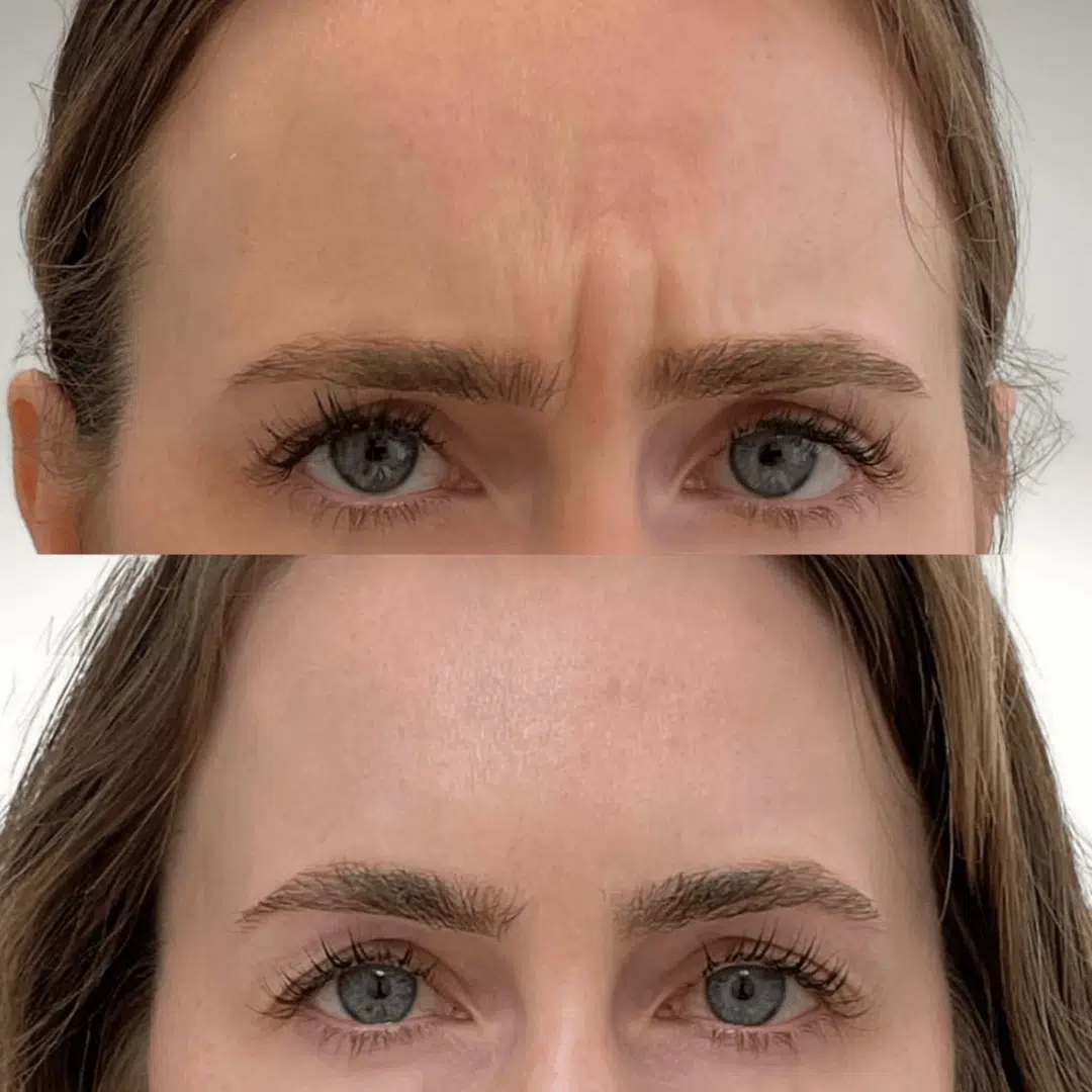 Glo Antiaging Calgary and Kelowna Botox before and after woman forhead