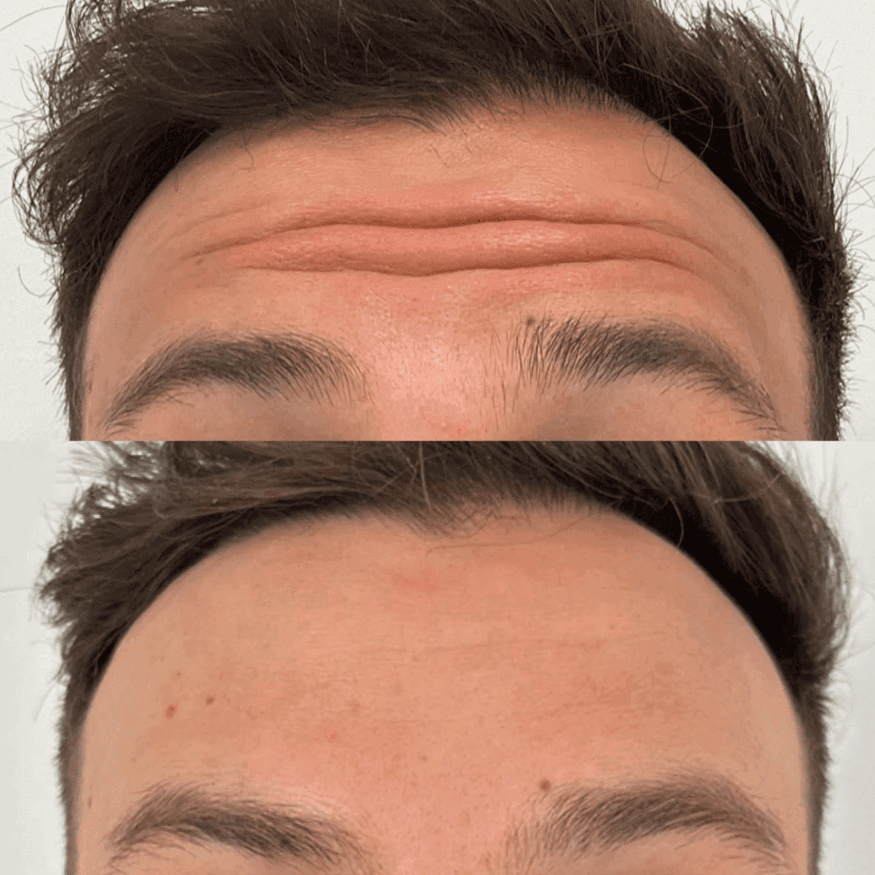 man botox before and after forehead