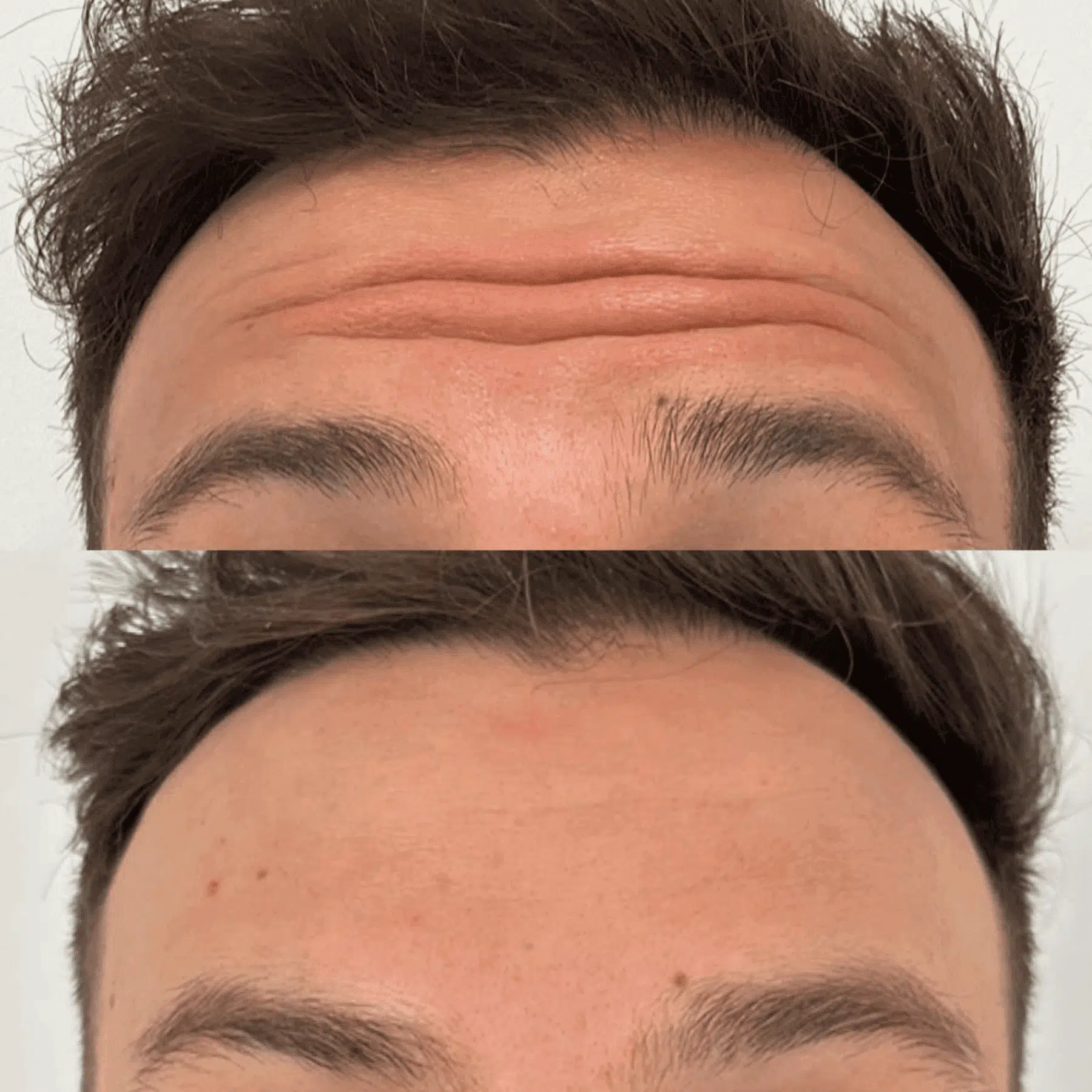man botox before and after forehead
