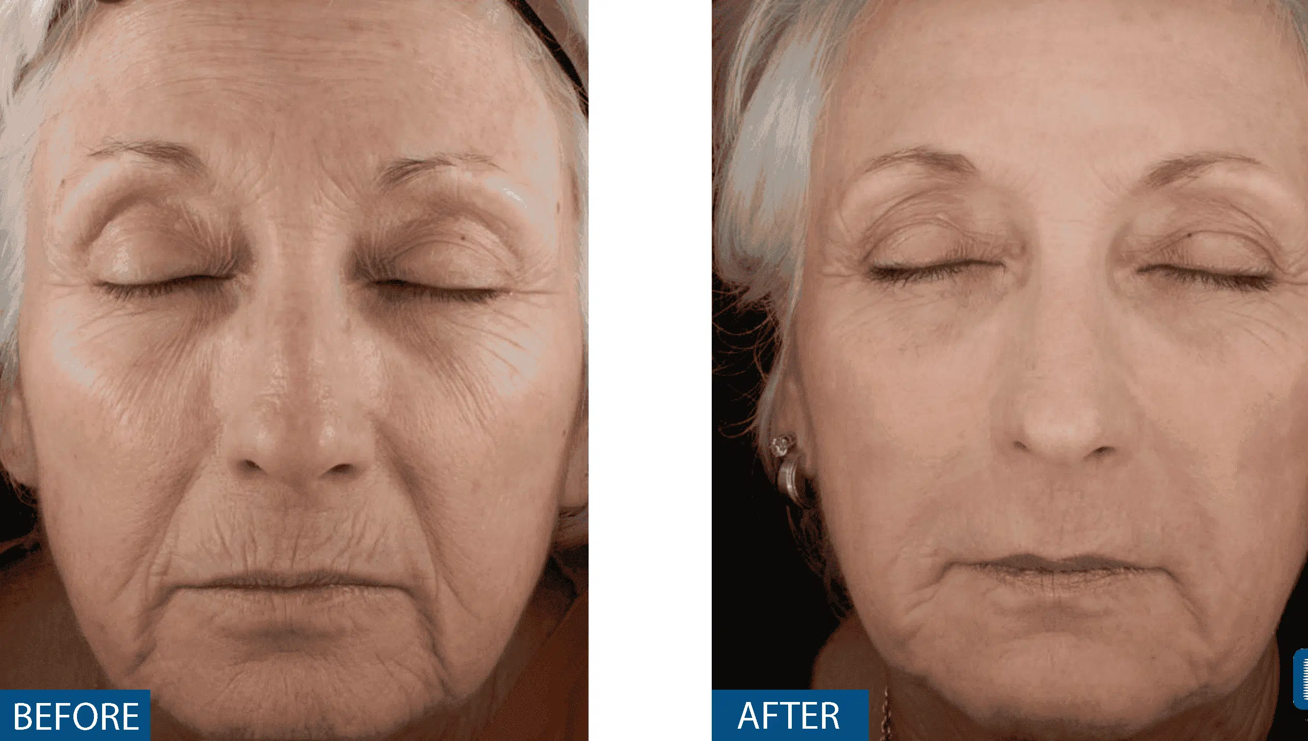 SylfirmX woman front profile before and after
