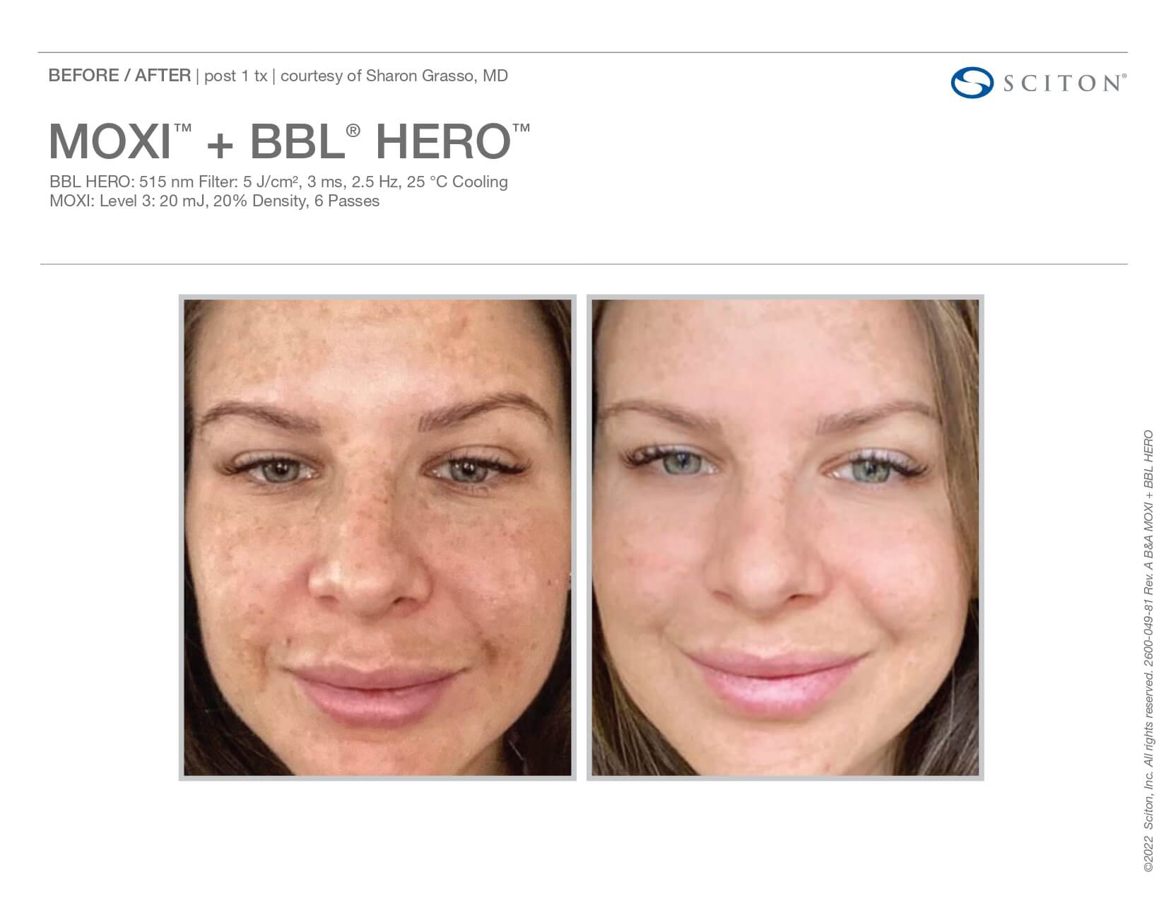 moxi BBL before and after woman front view