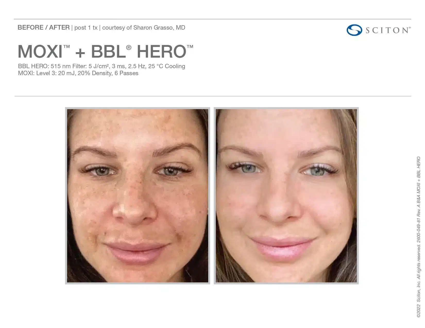 moxi BBL before and after woman front view