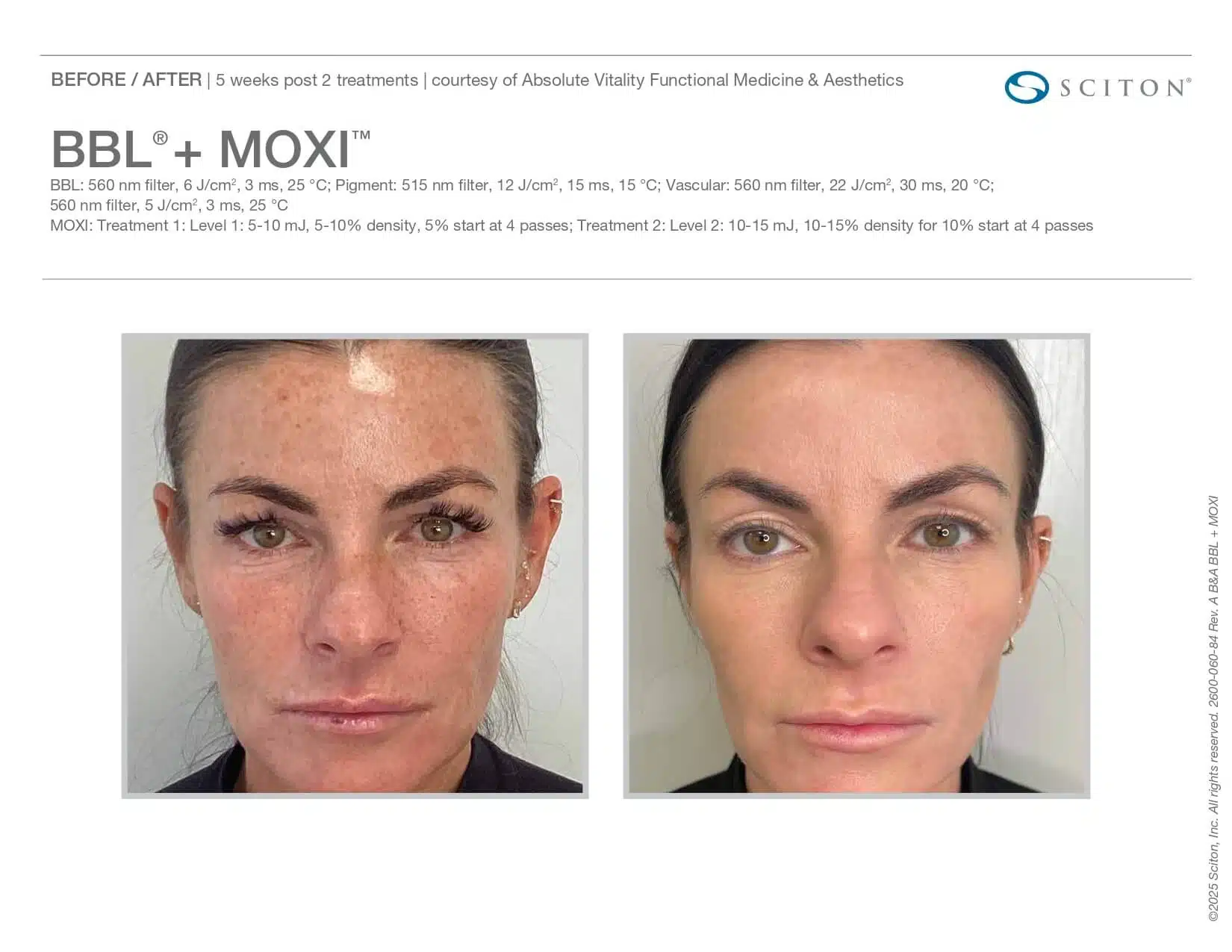 moxi BBL before and after woman front view