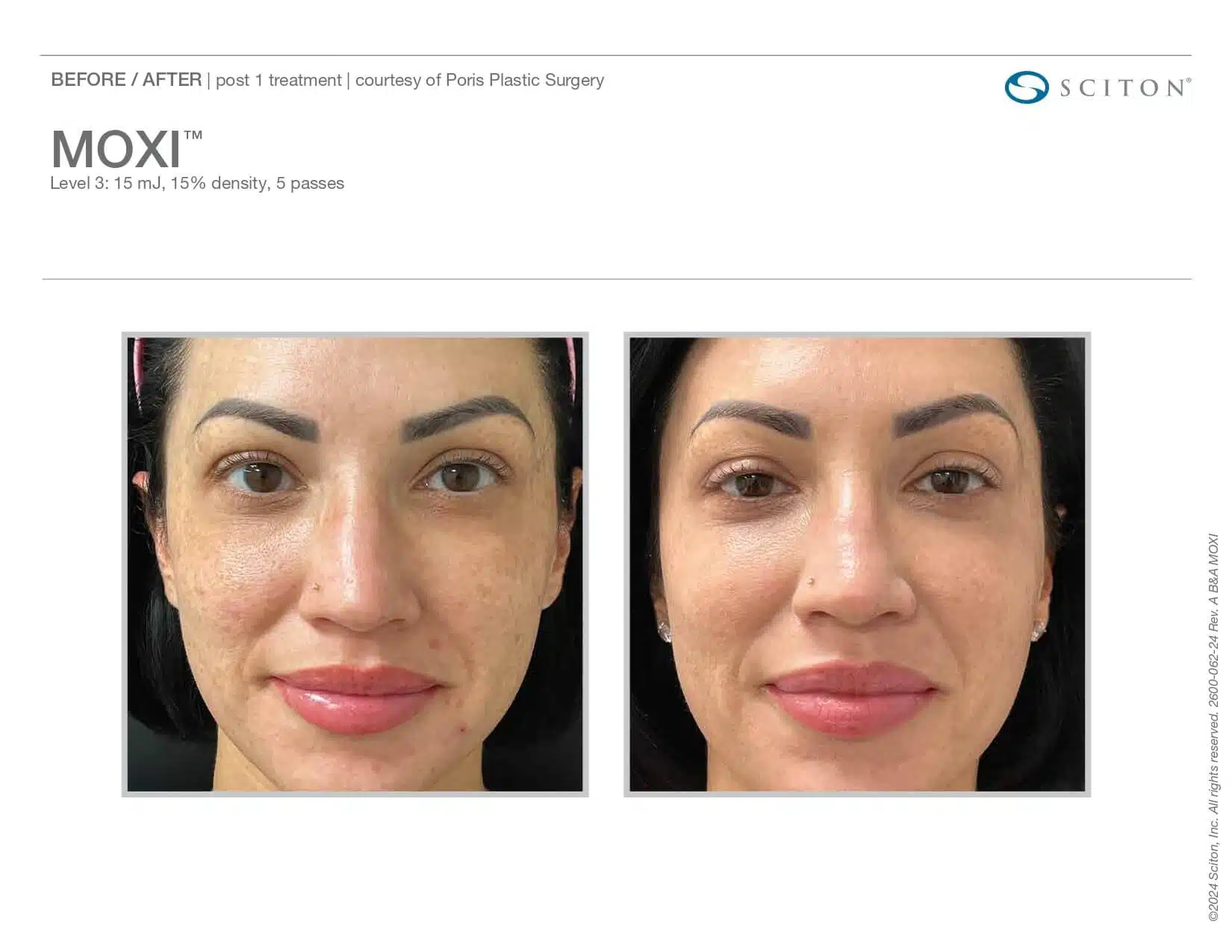 moxi before and after woman front view
