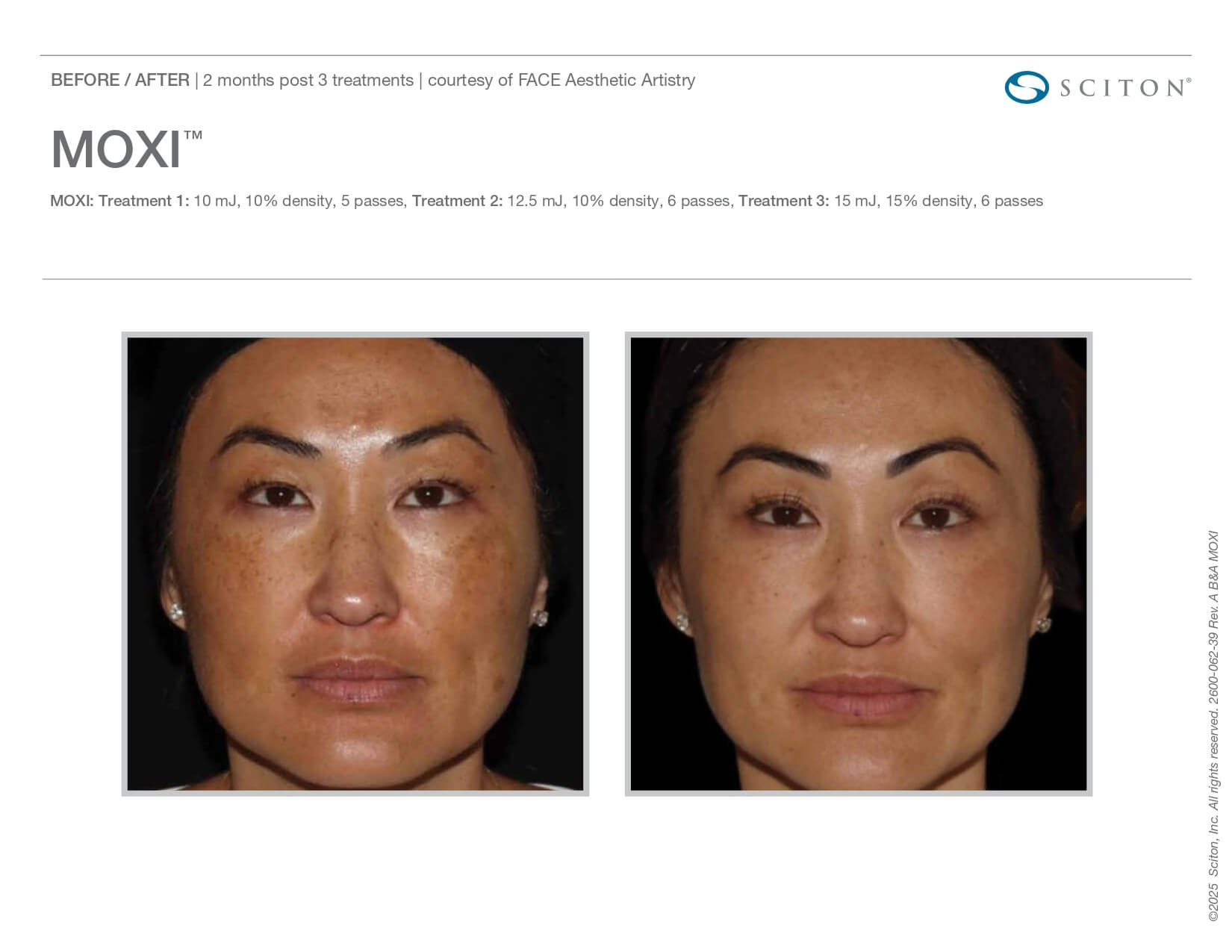 moxi before and after woman front view