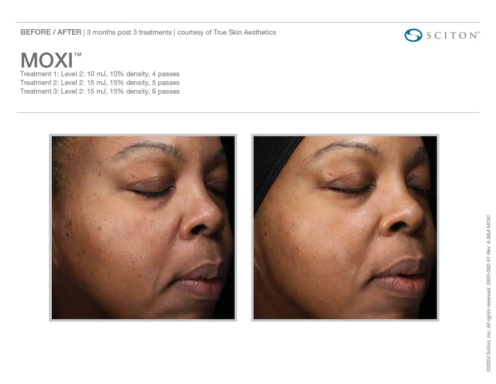 moxi before and after woman side view