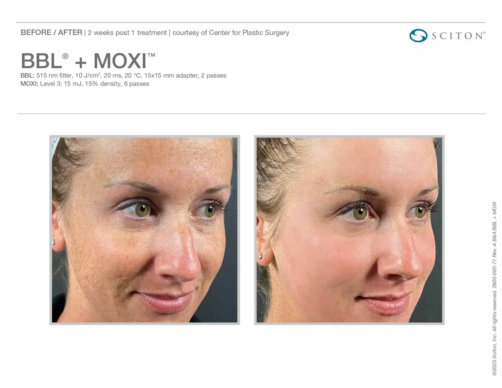 moxi before and after BBL woman side view